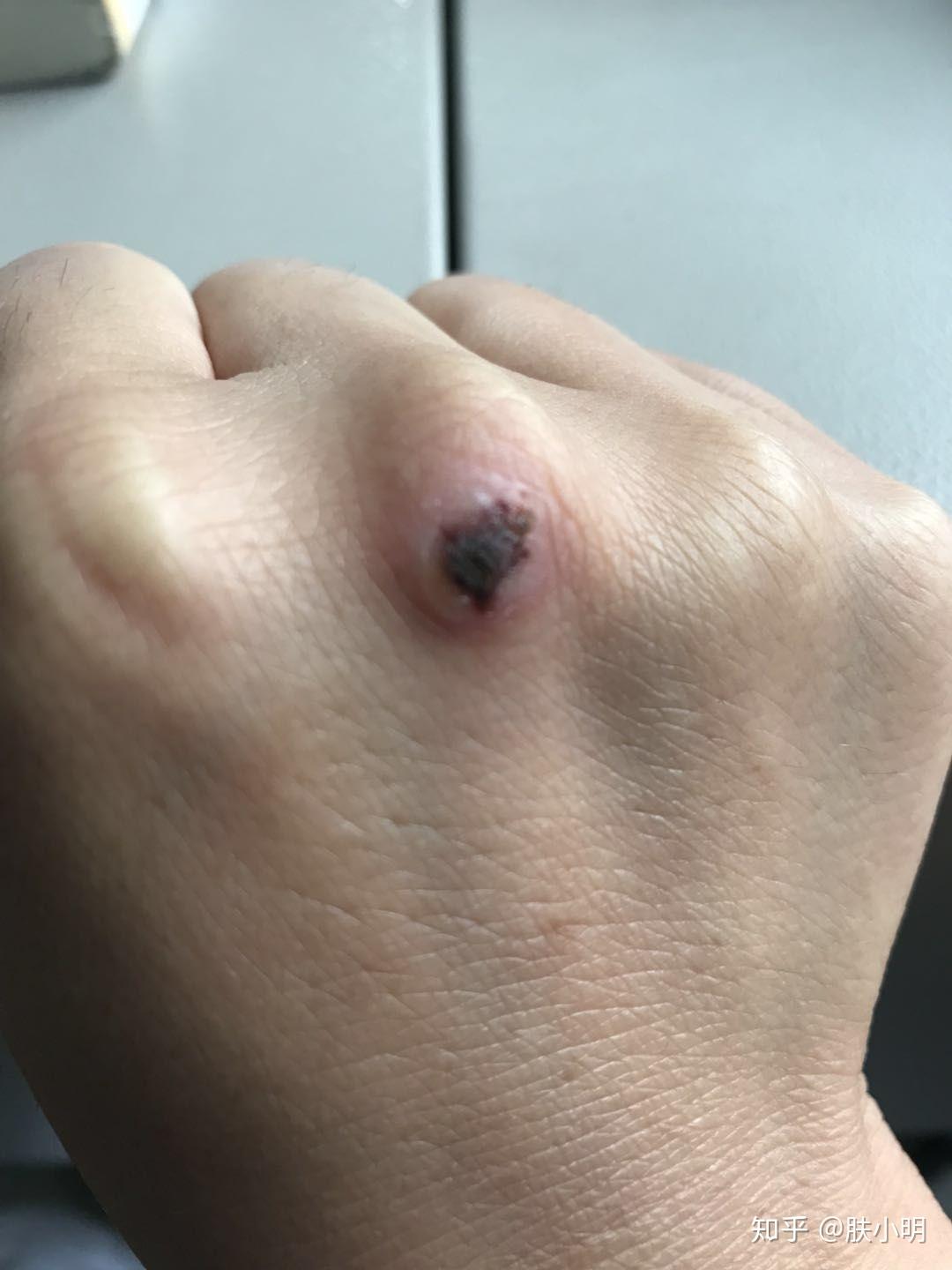 手上长的是鸡眼吗好害怕