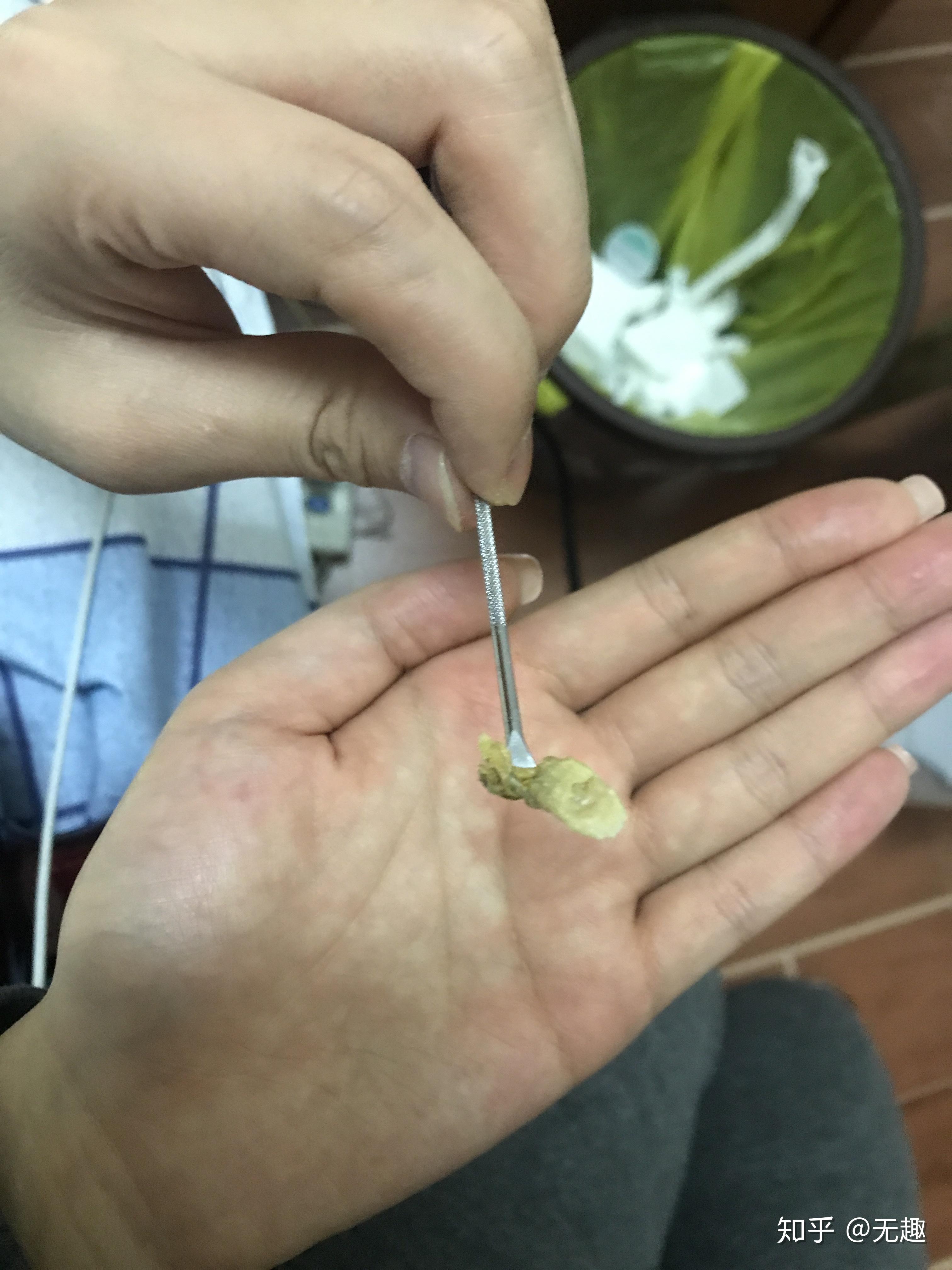 耳屎能大到什么程度? - 知乎