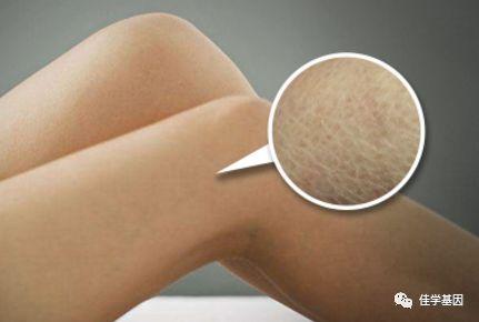 鱼鳞病担心遗传怎么办 知乎