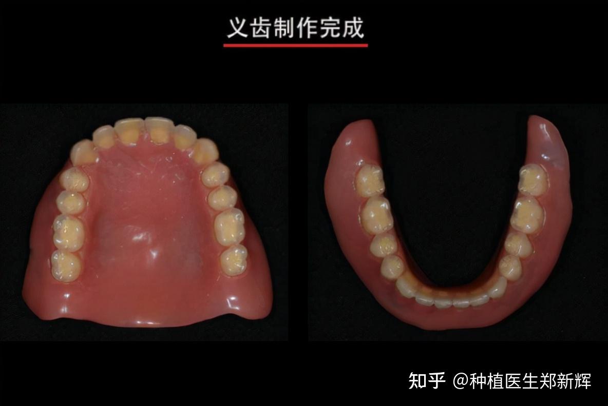 老年人意外缺失全口牙 但不想种植牙?可以试试这个方法