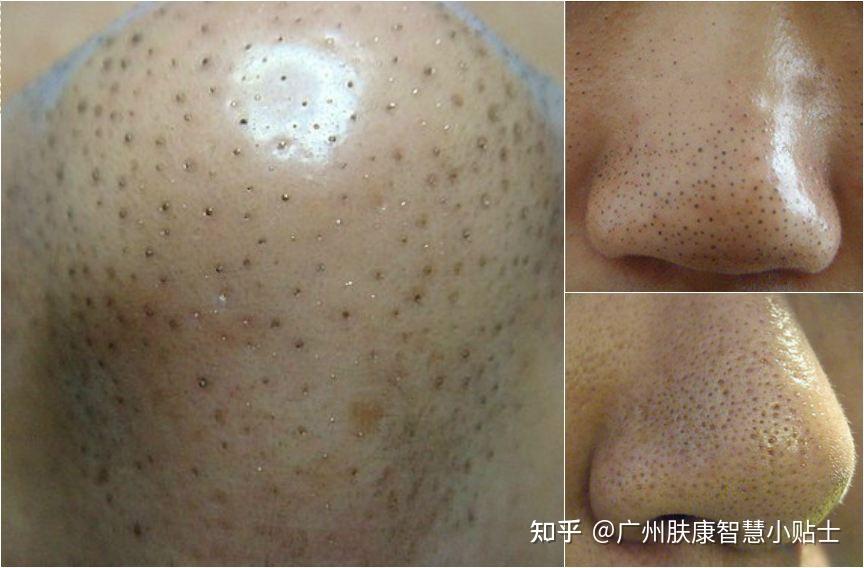 黑头怎么去除效果好?【广州肤康】 - 知乎
