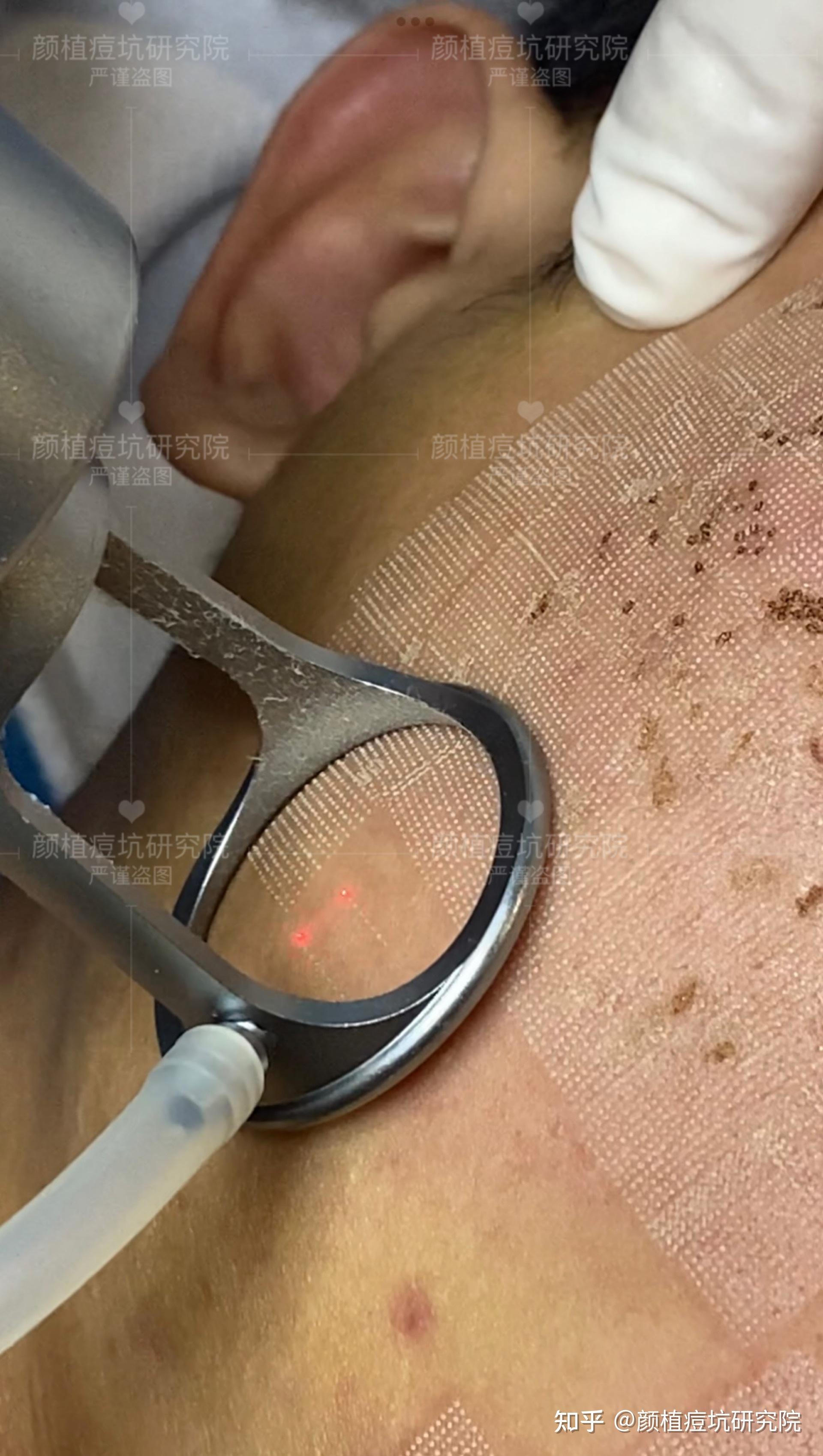 非剥脱点阵激光