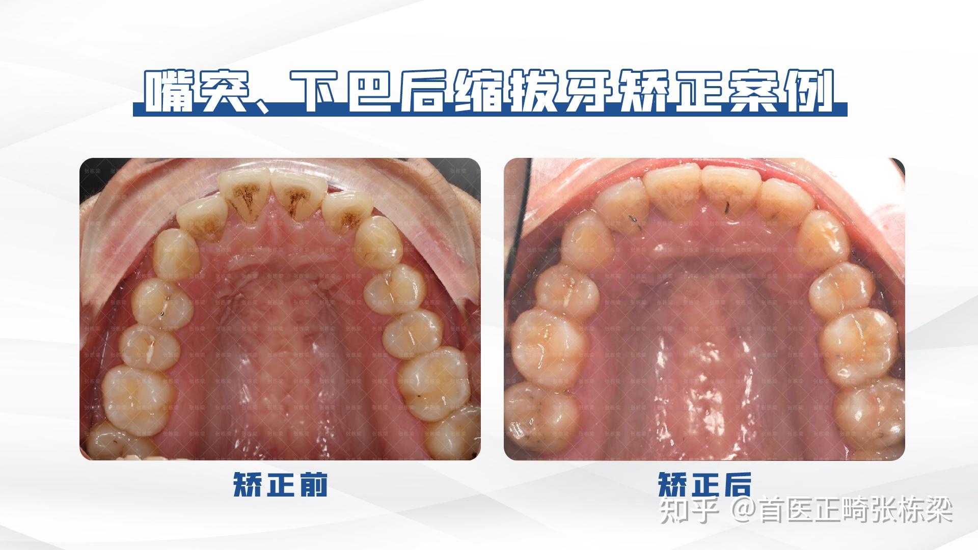 双颌前突拔牙病例-无托槽隐形矫治技术拔牙病例-医学