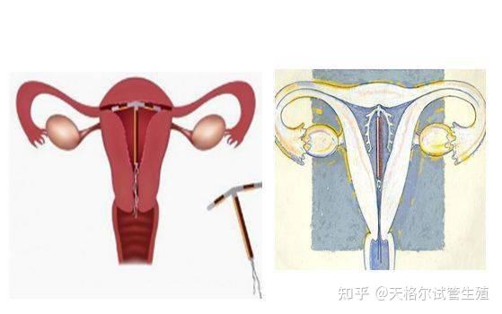 上曼月乐环后会更痛吗