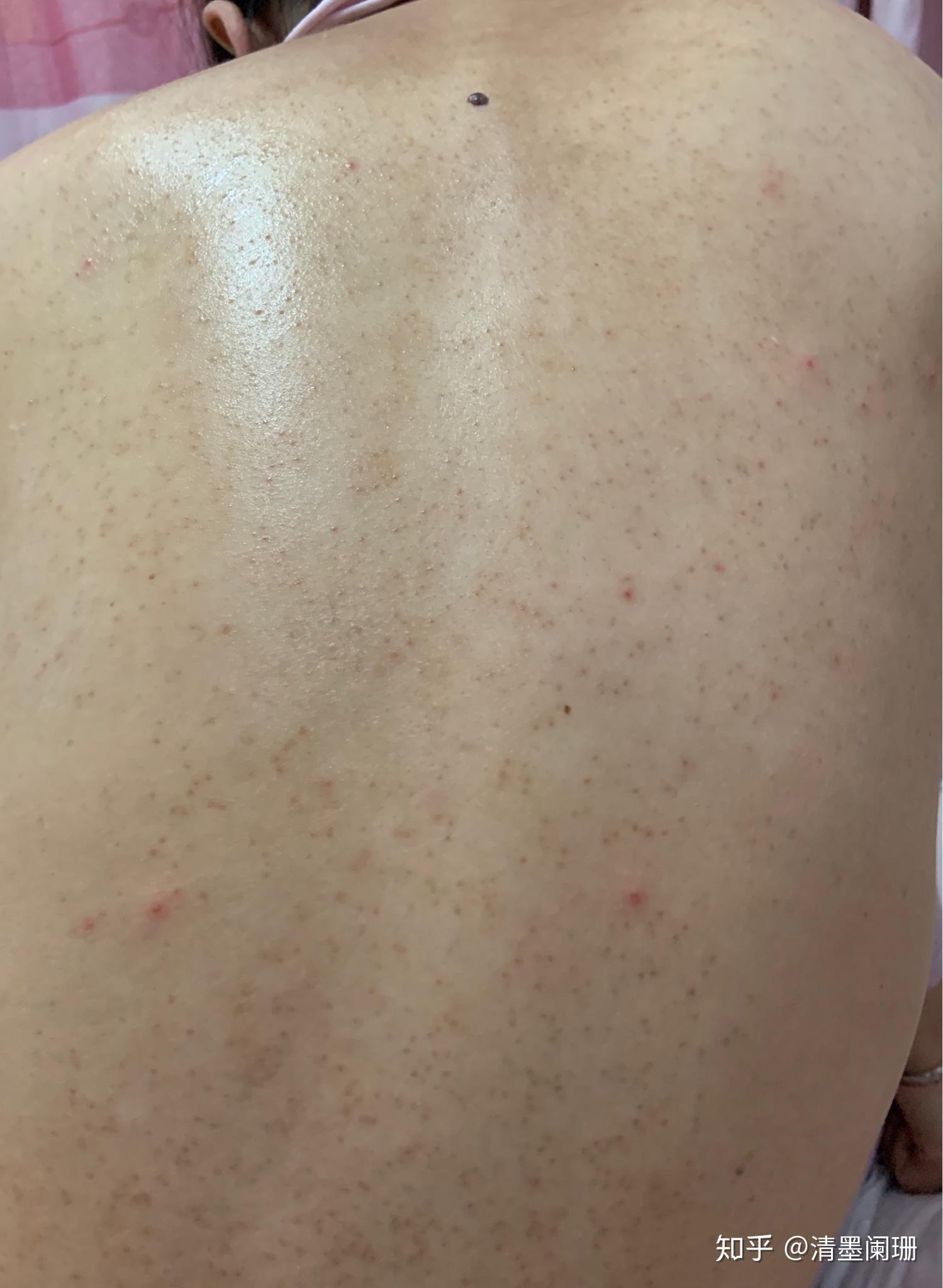 身上长有些小红点，还有的是水泡很痒不知是什么 皮肤起小红点小水泡发痒是什么病？