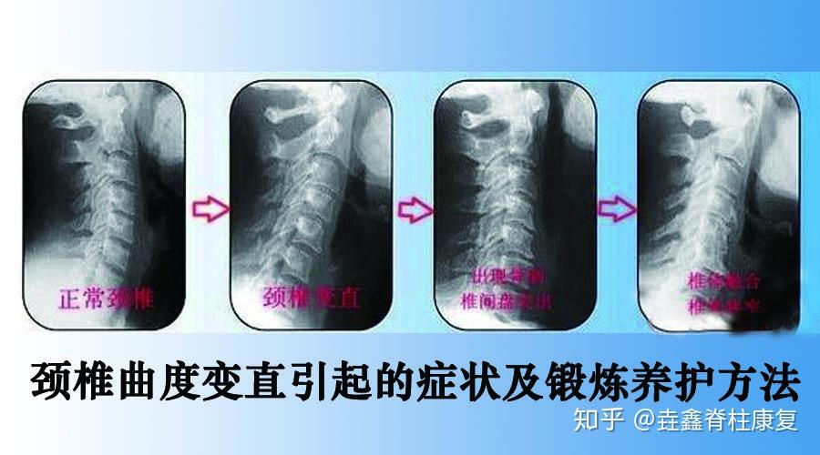 颈椎生理曲度变直如何恢复?