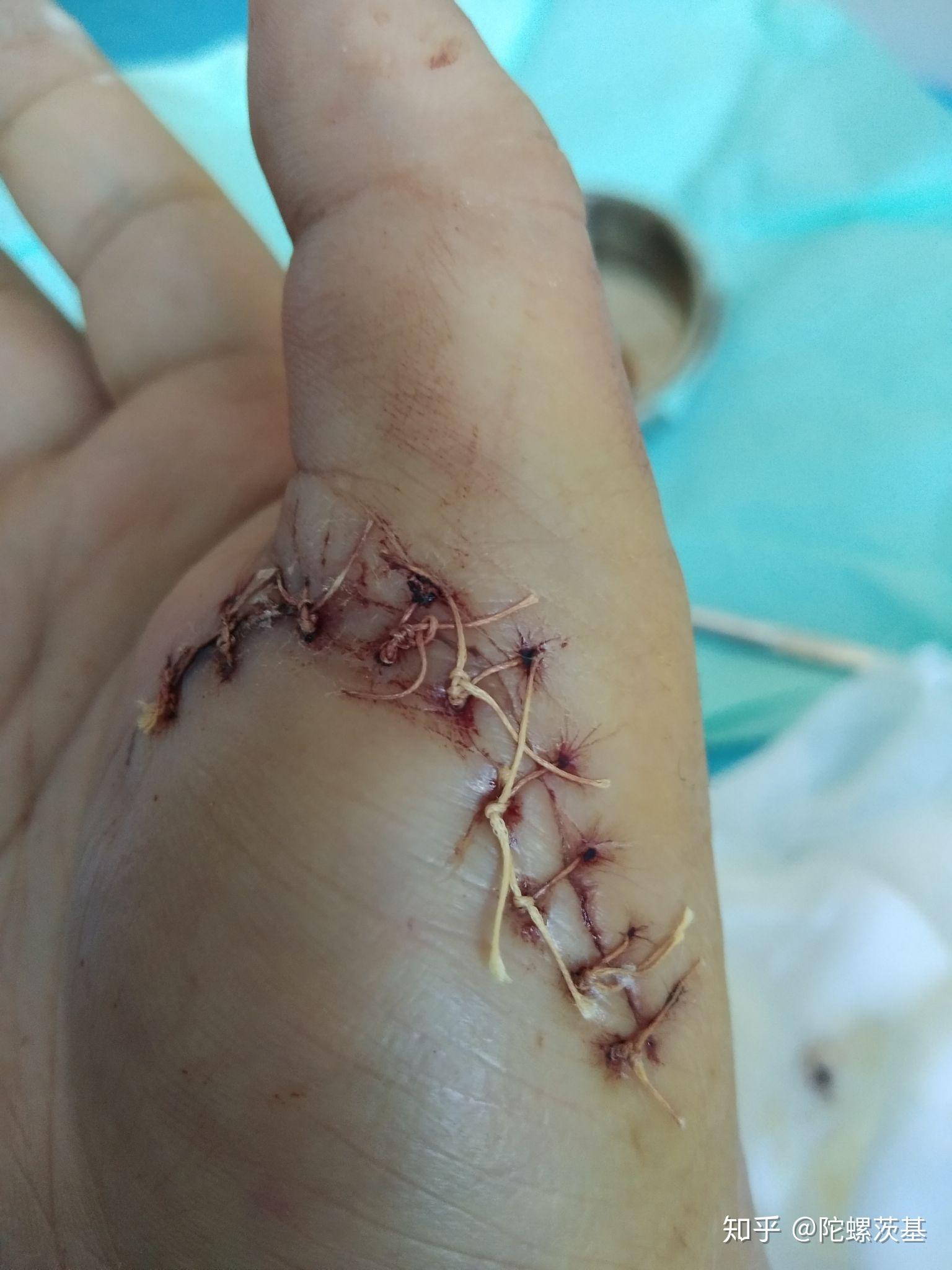 右手大鱼际肌肉断裂外展肌肌腱断裂