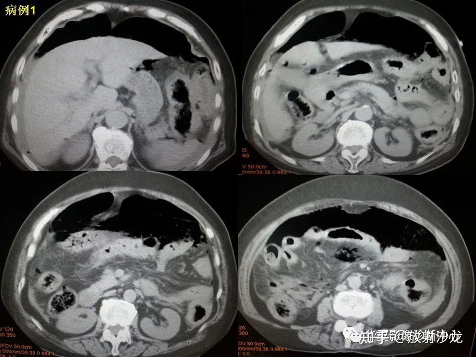 消化道穿孔CT图片