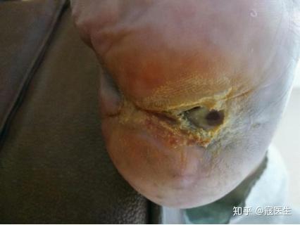 杨川教授的糖尿病足居家管理系列报道一
