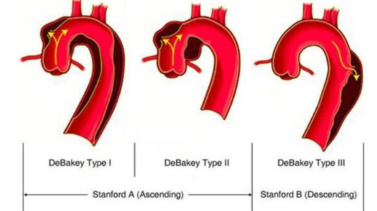主动脉夹层stanford图片
