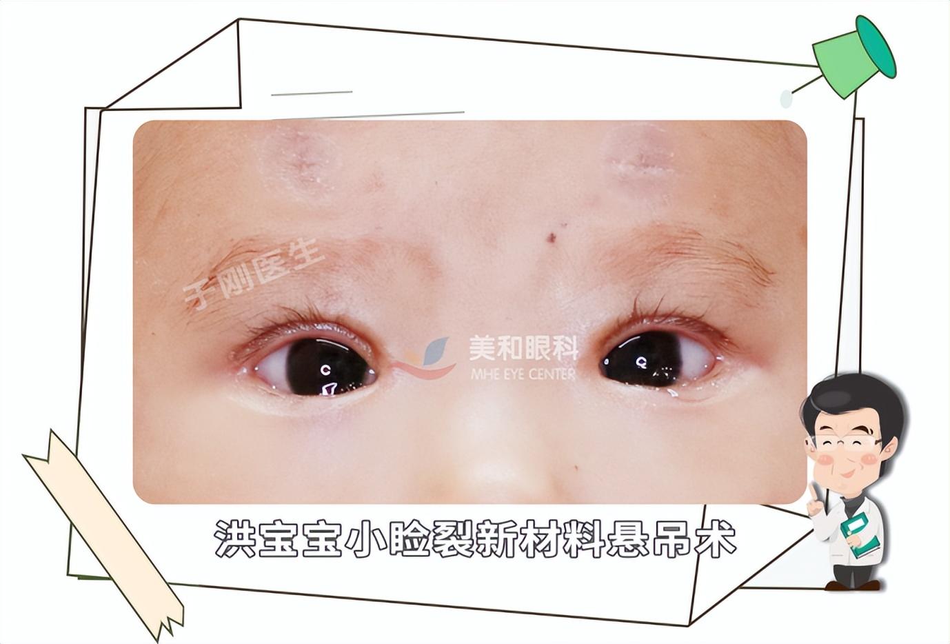 小睑裂综合征漫漫求医路