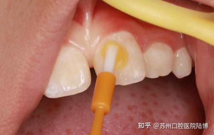 先来说说氟是什么.氟化物是一种经临床证实的高效抑菌化学材料.