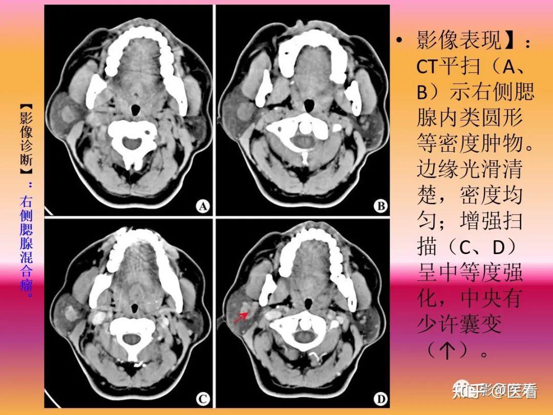 腮腺是什么疾病腮腺ct诊断与鉴别诊断