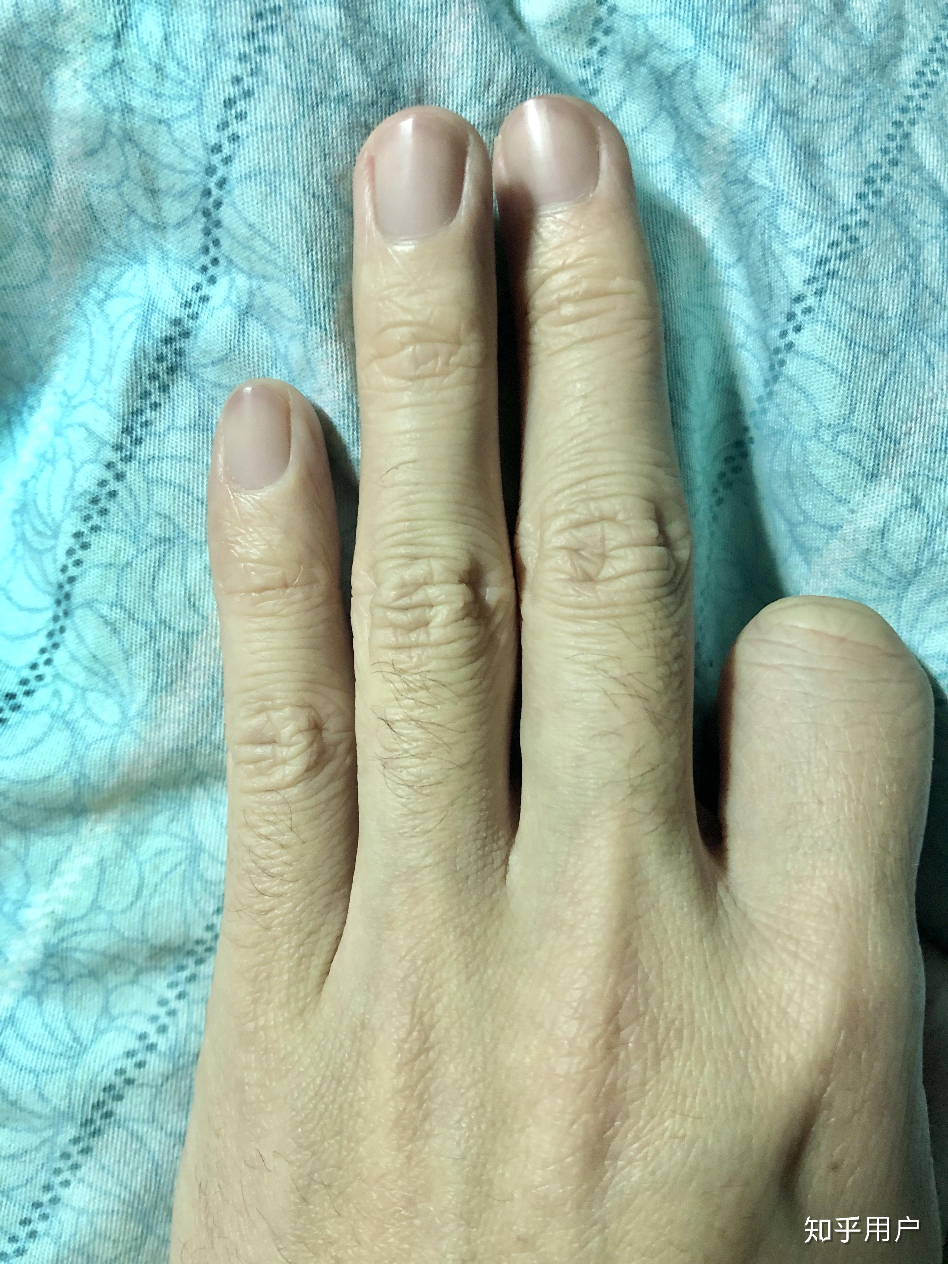 请问鱼鳞病患者的手都是老人手吗? - 知乎