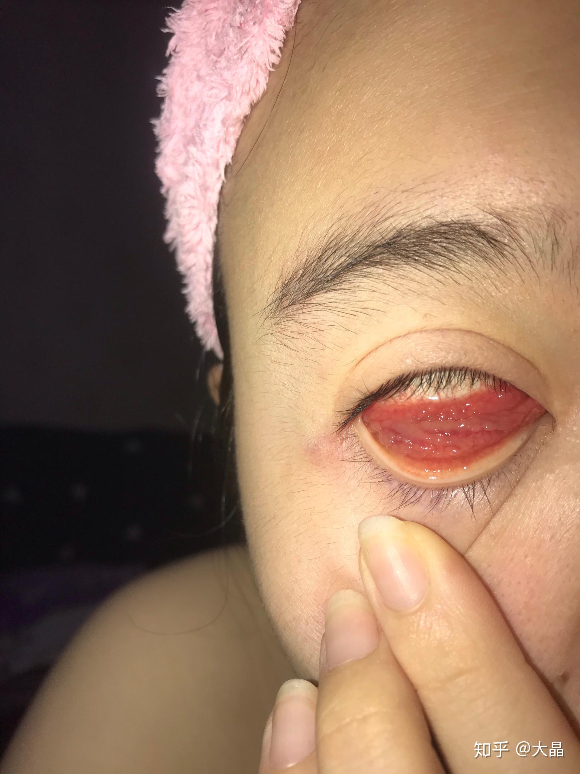 戴隐形导致上下眼皮有很多滤泡该怎么办