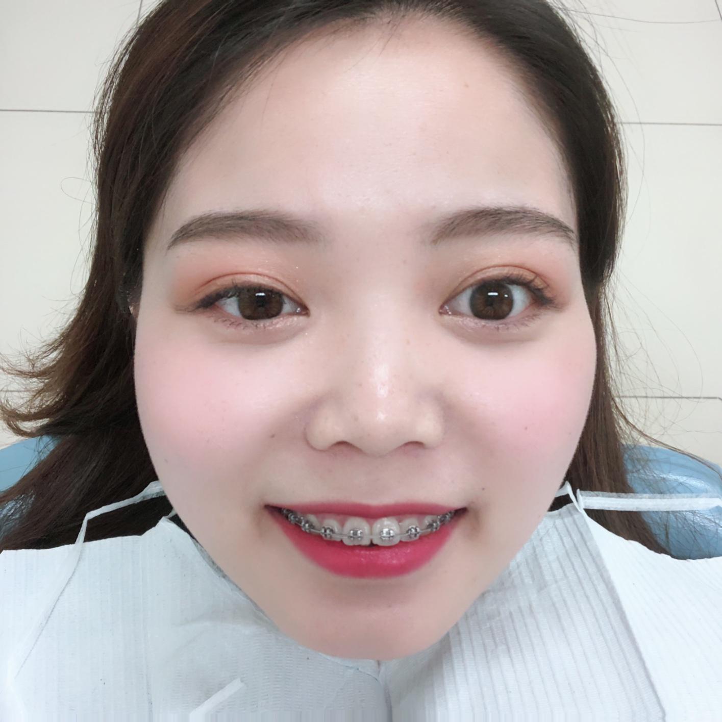 为何戴牙套会形成牙套脸