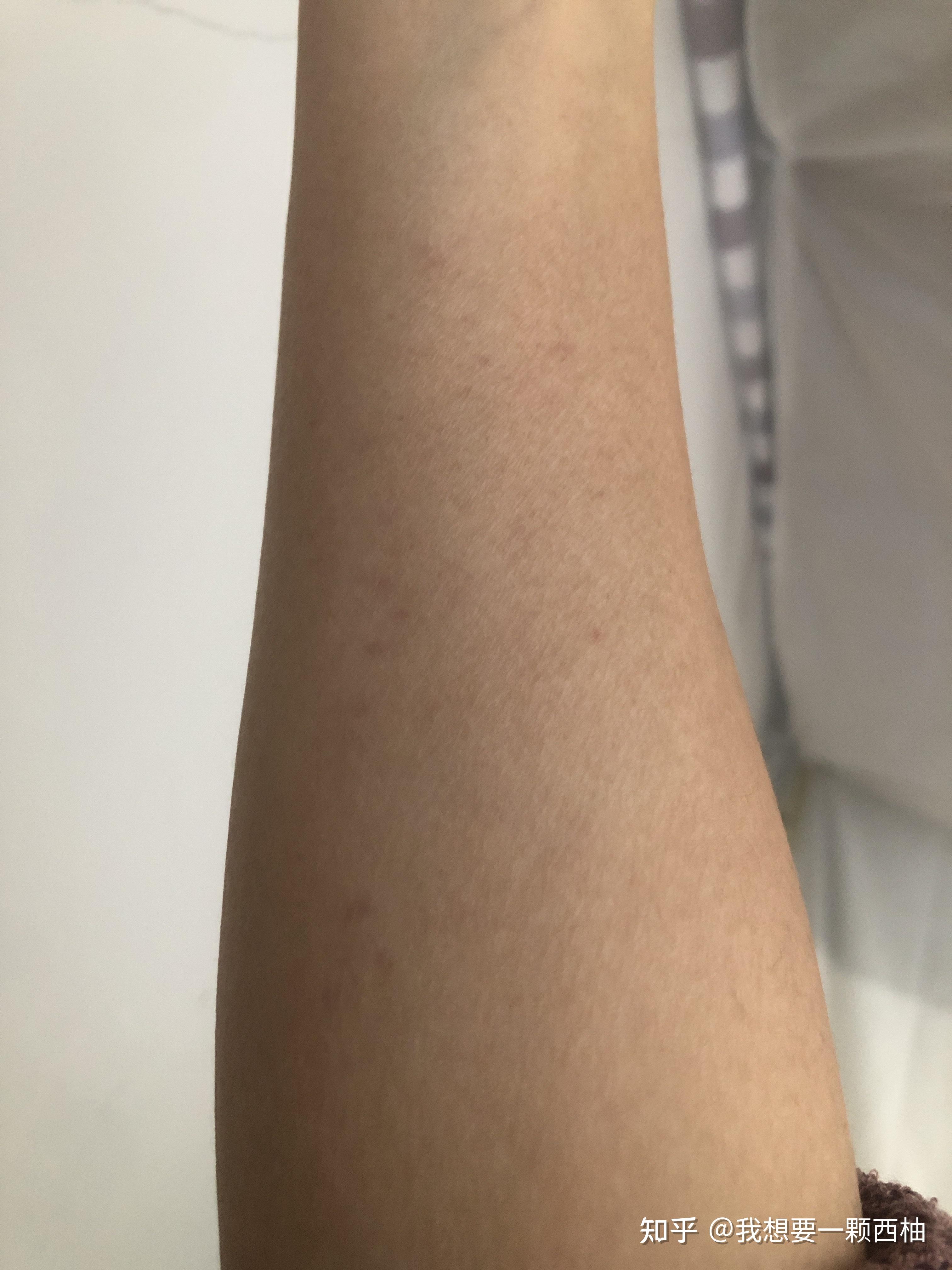 手臂皮肤突然出现紫色斑点什么原因