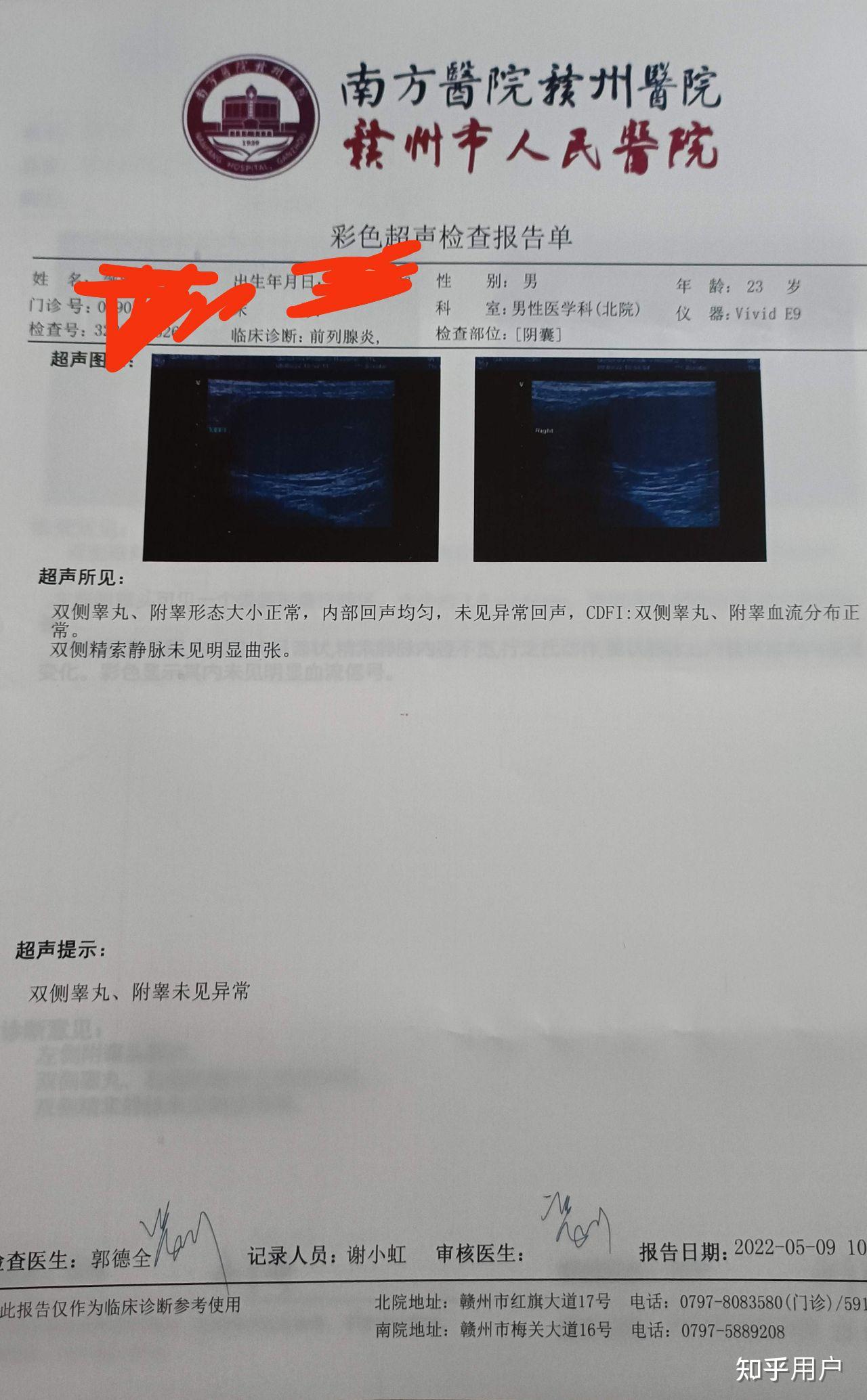 睾丸附睾囊肿? - 知乎