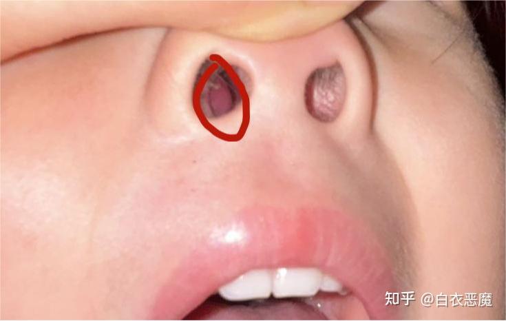 鼻腔里面那个肉球是啥?红肿要紧不?