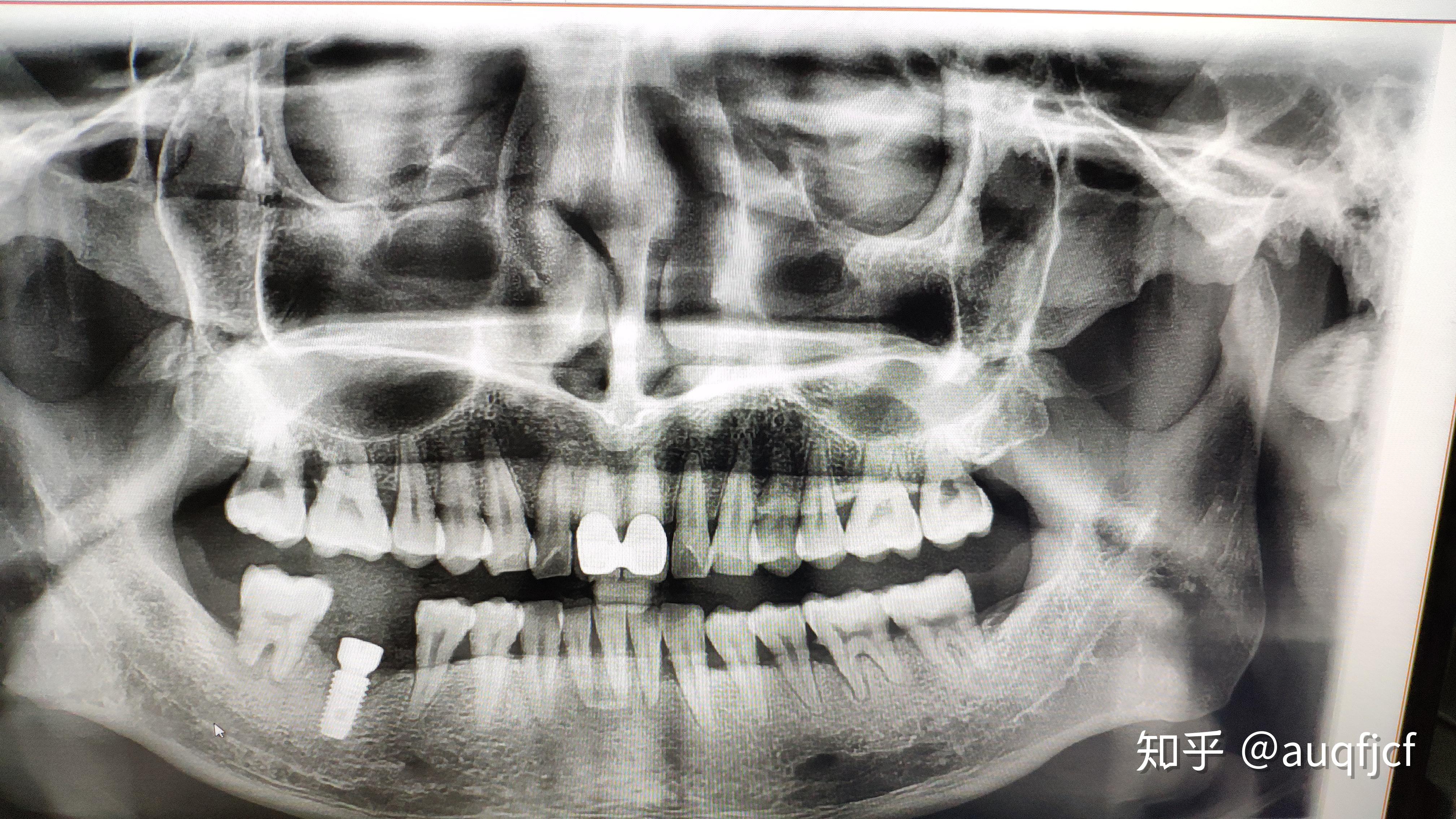 门牙缺失种植牙修复 - 好大夫在线