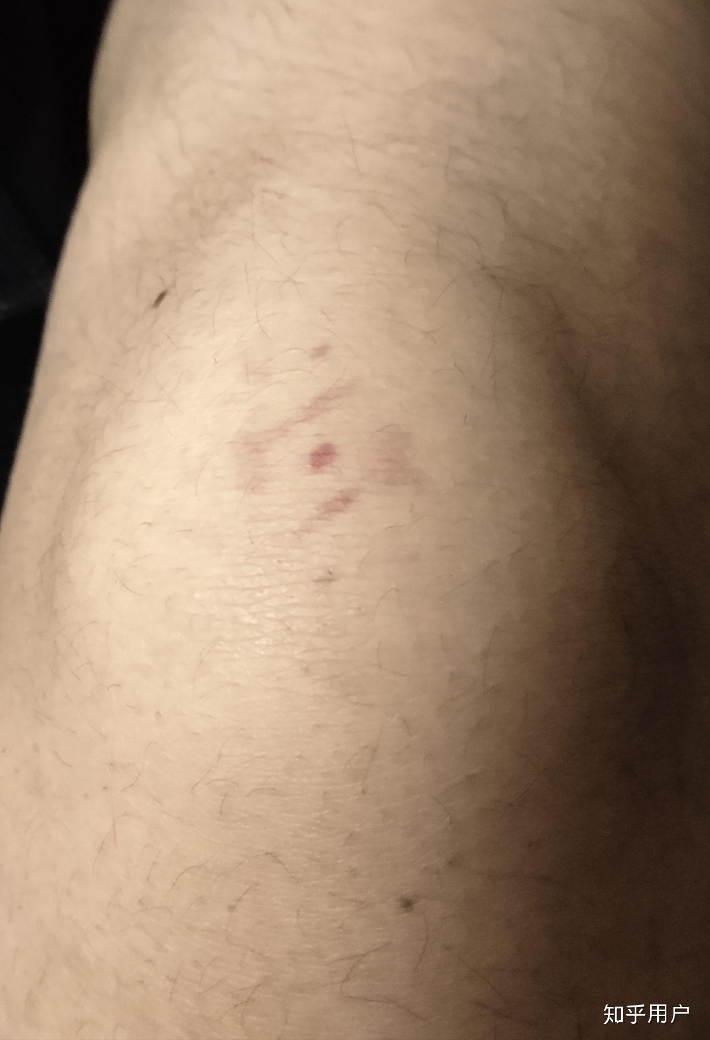 膝盖有紫红色瘀斑无痛图片