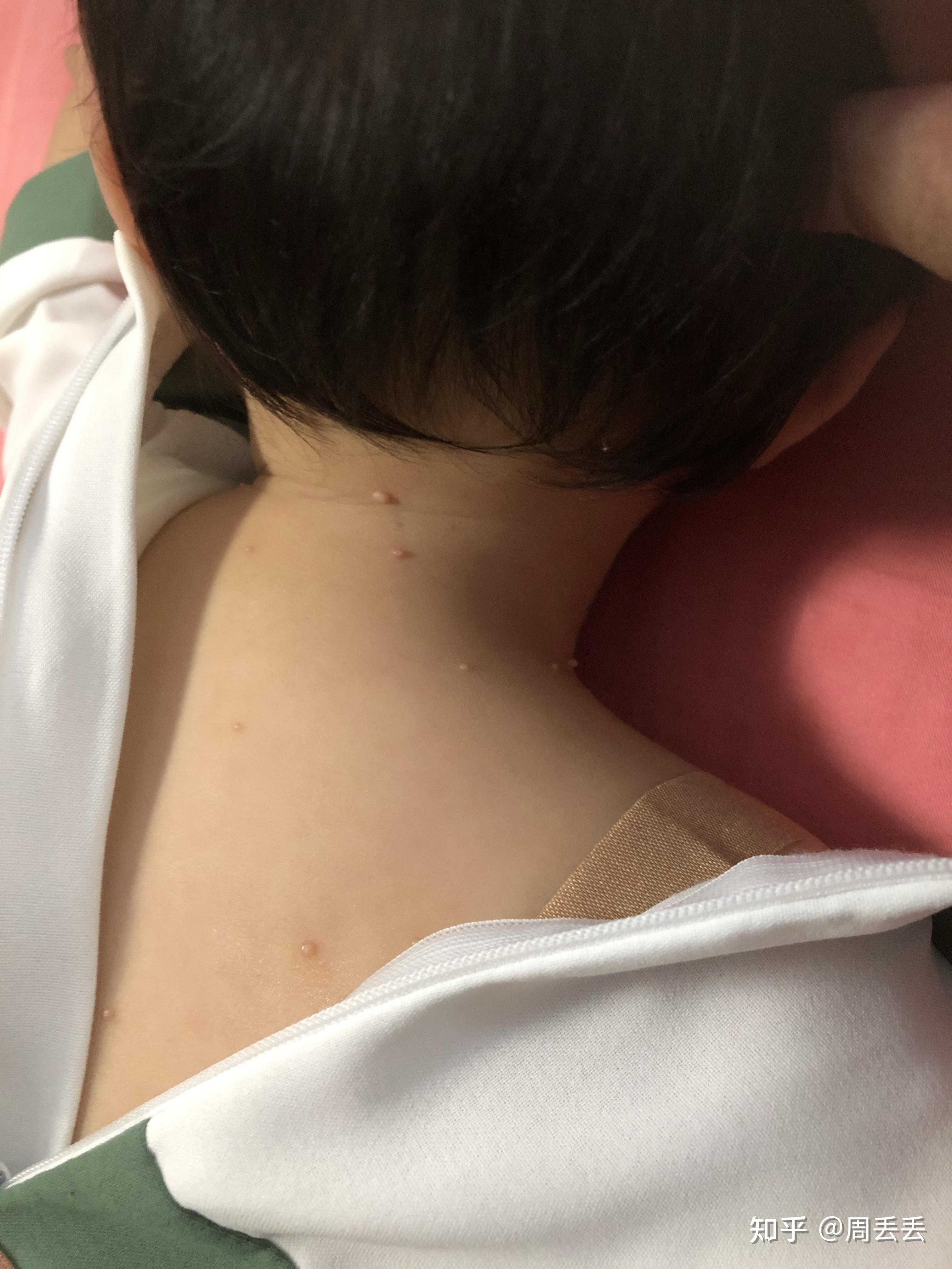 一岁宝宝传染性软疣如何治疗?