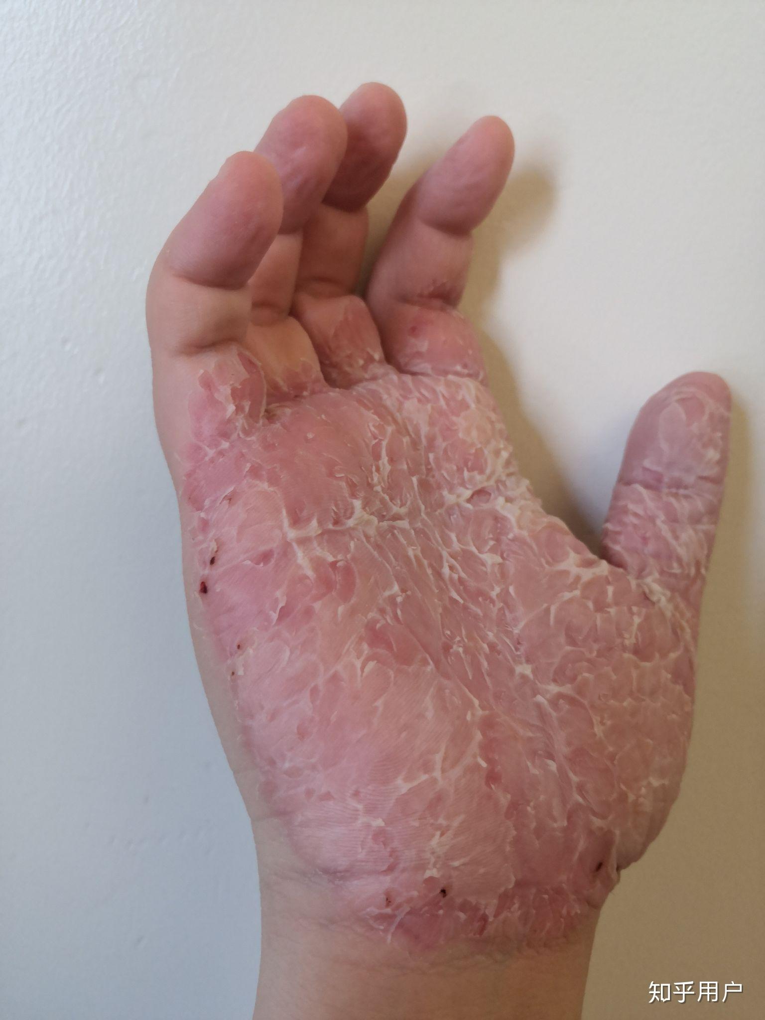 如何控制不自觉的没完没了的撕手皮如何恢复手指皮肤的状态比如已经撕