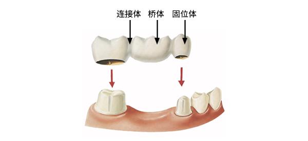 悬臂固定桥图片