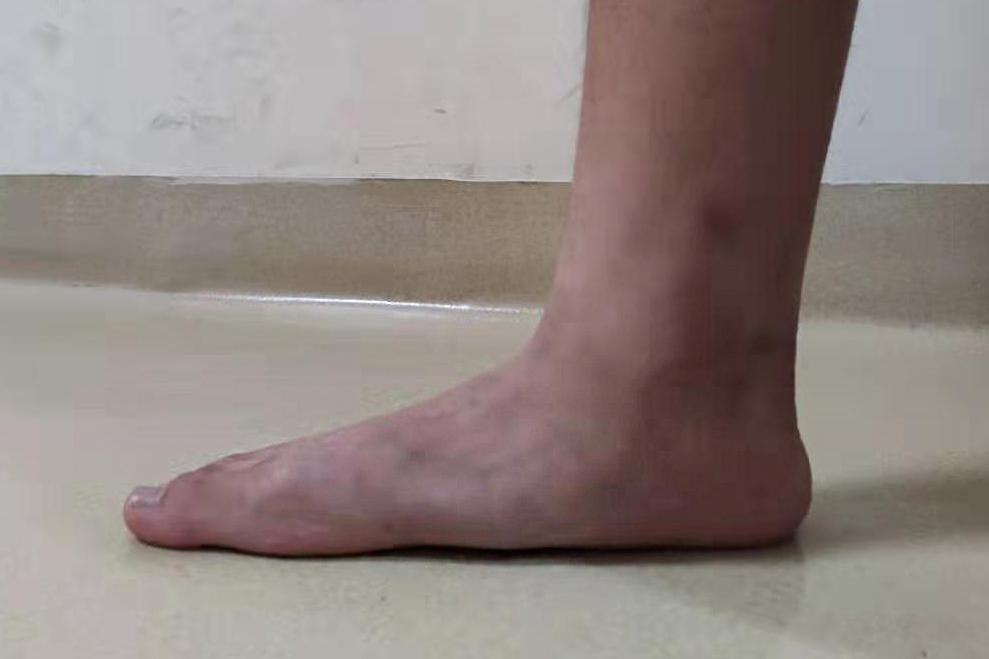 为什么同样是扁平足 有的人可以徒步旅行 有的人却走不了远路 知乎 为什么同样是扁平足 有的人可以徒步旅行 有的人却走不了远路 知乎