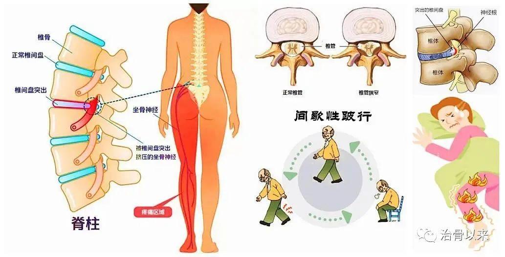 当自己身上出现腰腿痛的症状时