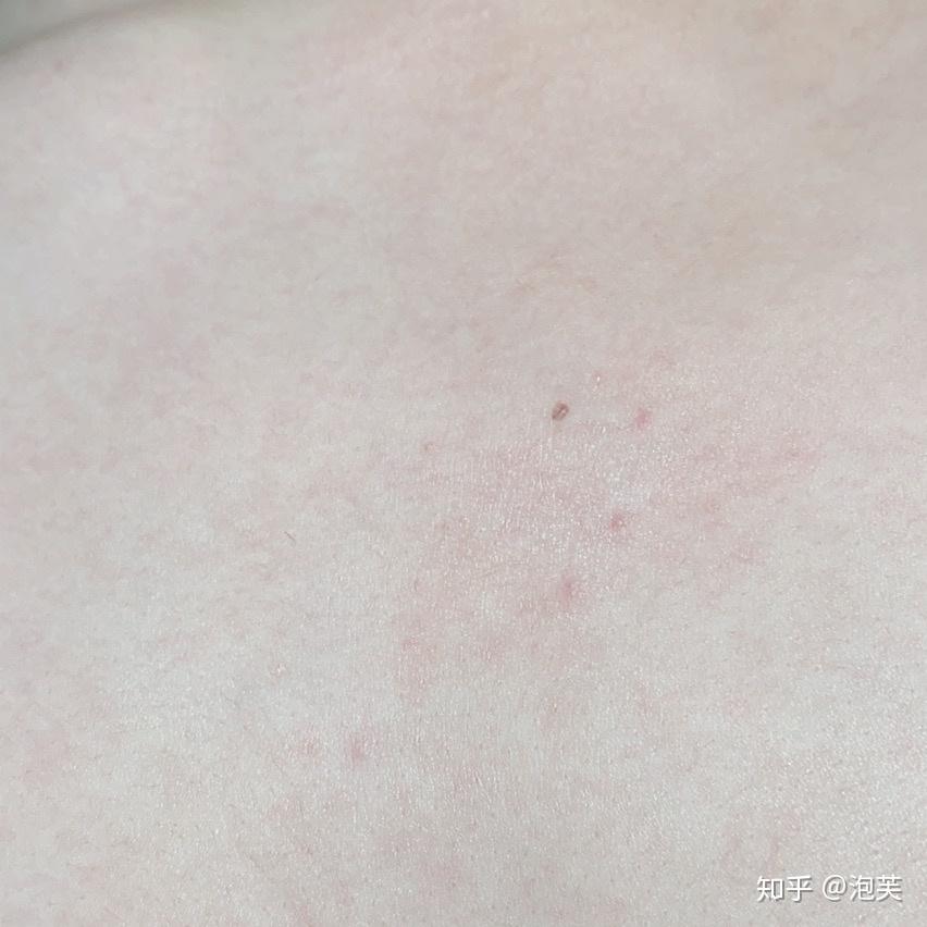 马拉色菌毛囊炎 治疗中