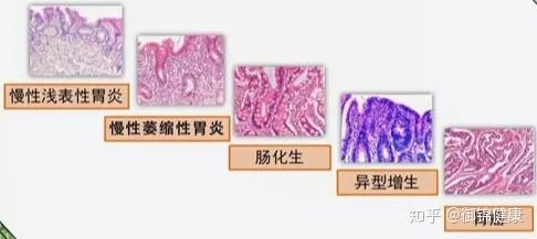 慢性胃炎会发展成胃癌吗 消化科医生为你解读 癌前疾病 病变 知乎