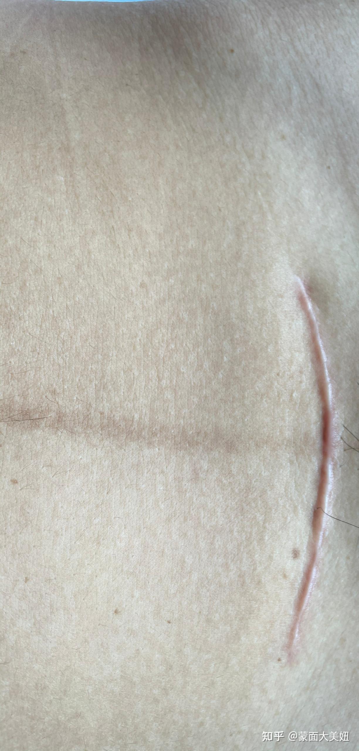 竖剖腹产后的疤痕图片图片