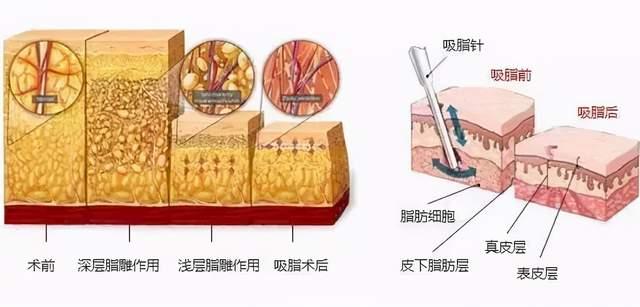 吸脂后脂肪没了,皮肤会不会突然松弛掉?