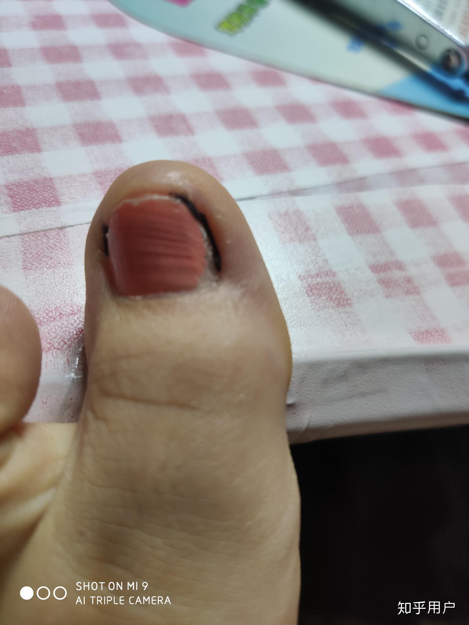 脚趾大拇指指甲两侧往肉里长怎么办啊? - 知乎