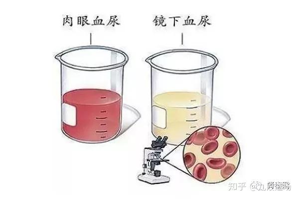 【肾病】红色的尿就是血尿吗？血尿都是怎么引起的？ - 知乎
