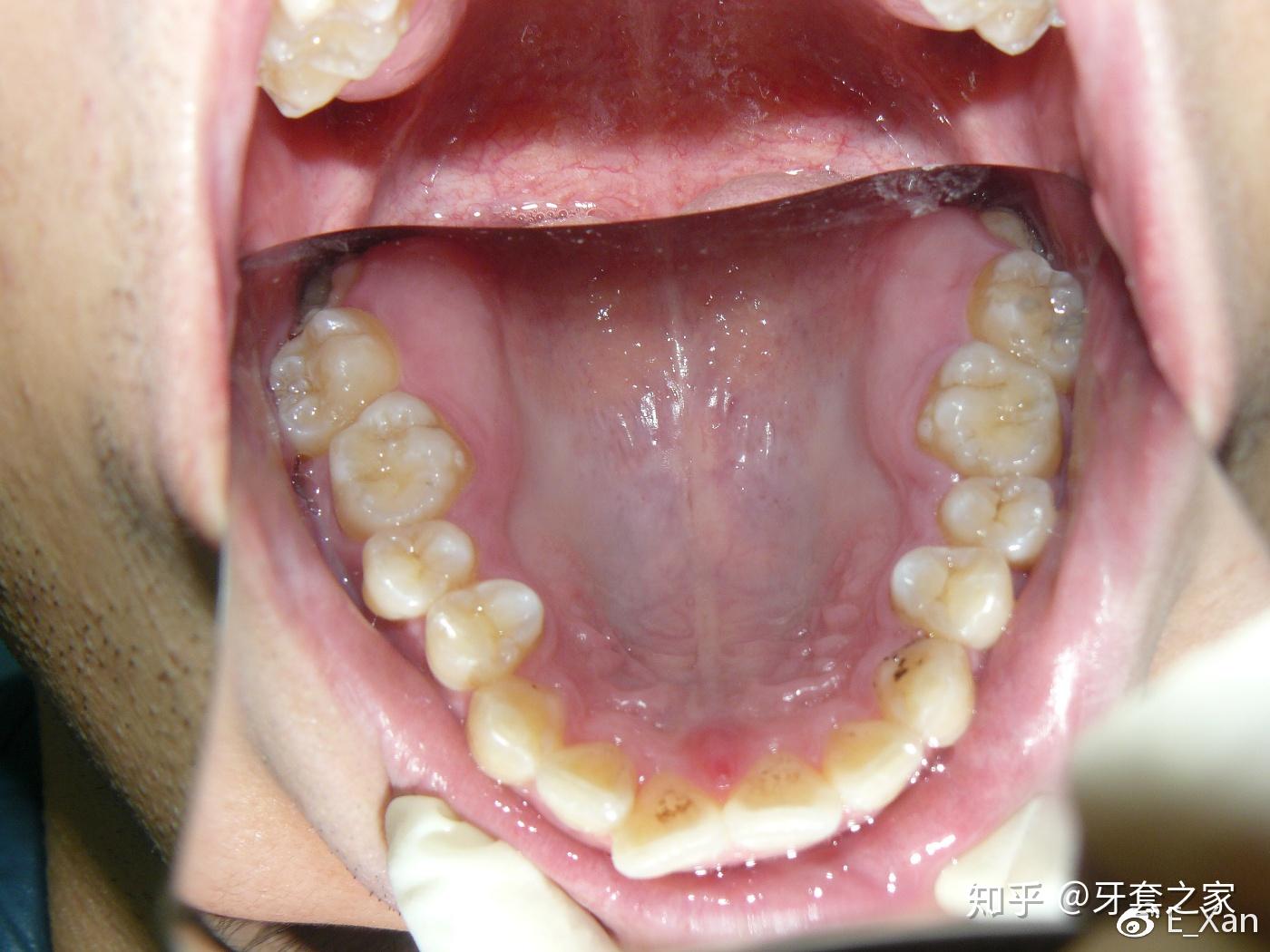 人一般有多少颗牙齿？ - 知乎