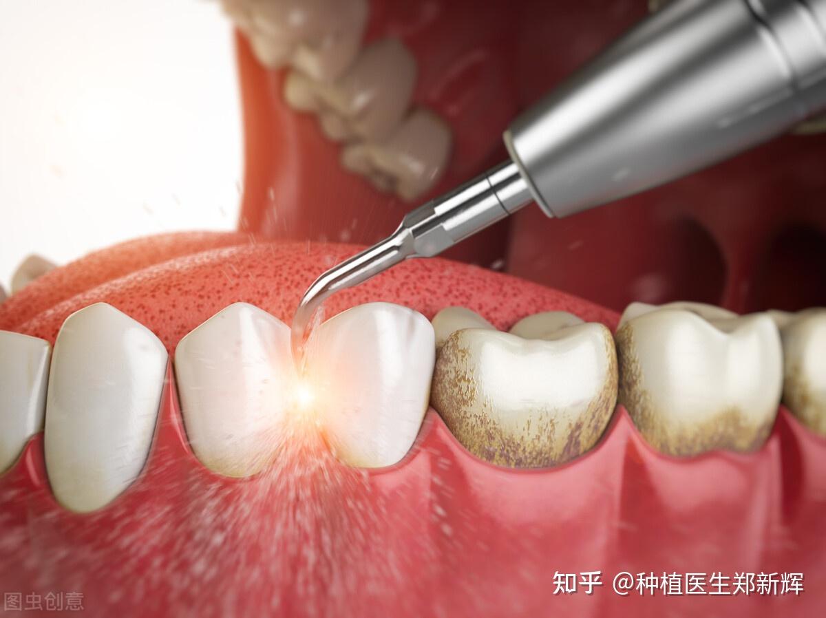 牙龈萎缩能会恢复吗？ - 知乎