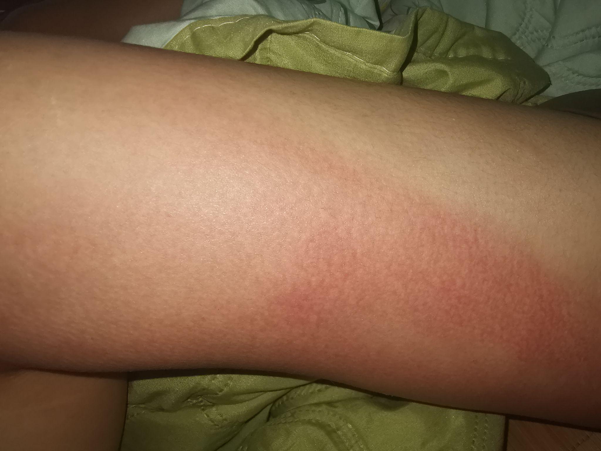 但是现在走路没什么大问题了哈,只是大腿会发紫,但习惯了就好.