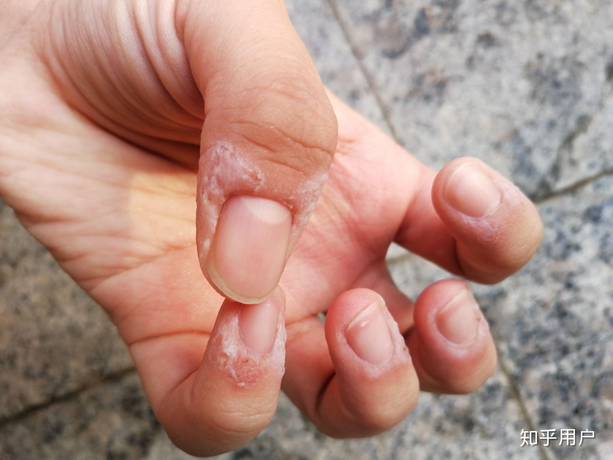 咬手皮是一种怎样的心理