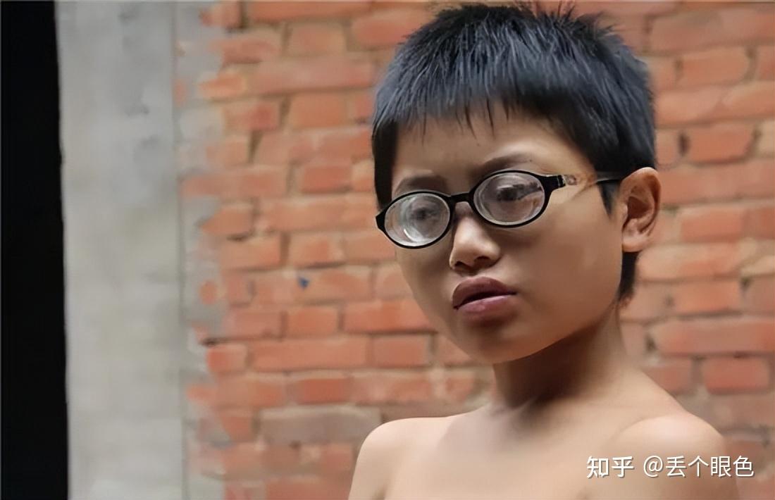 高度近视应该注意些什么? - 知乎