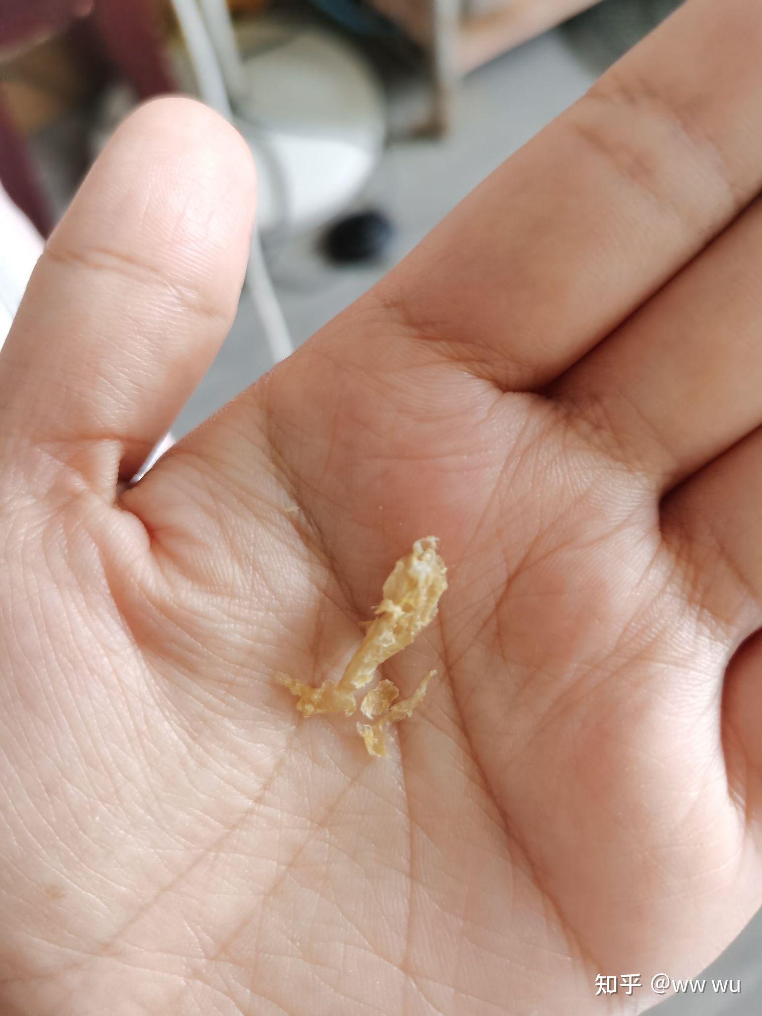 为什么我掏出来的耳屎是桶状的,就是一层薄膜粘附在耳壁上? - 知乎