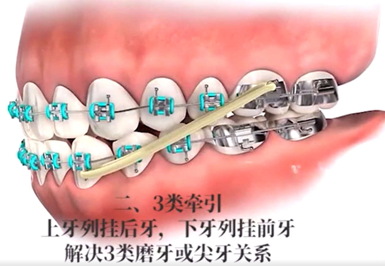 来说说牙齿矫正挂小皮筋是什么感受
