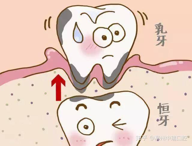 兒童蛀牙防護宜早不宜遲