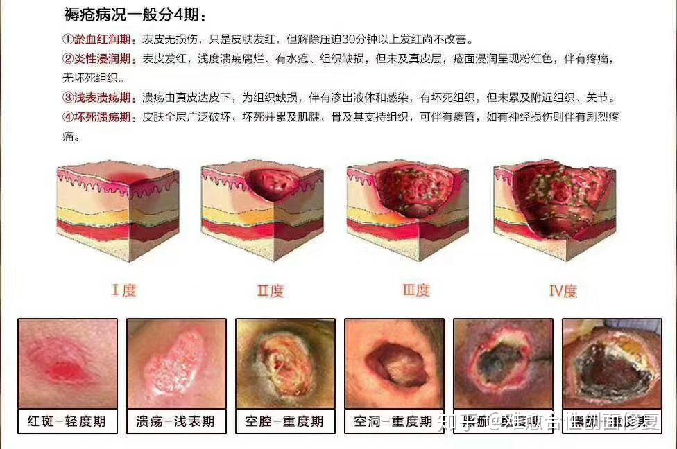 如何预防老人褥疮? - 知乎