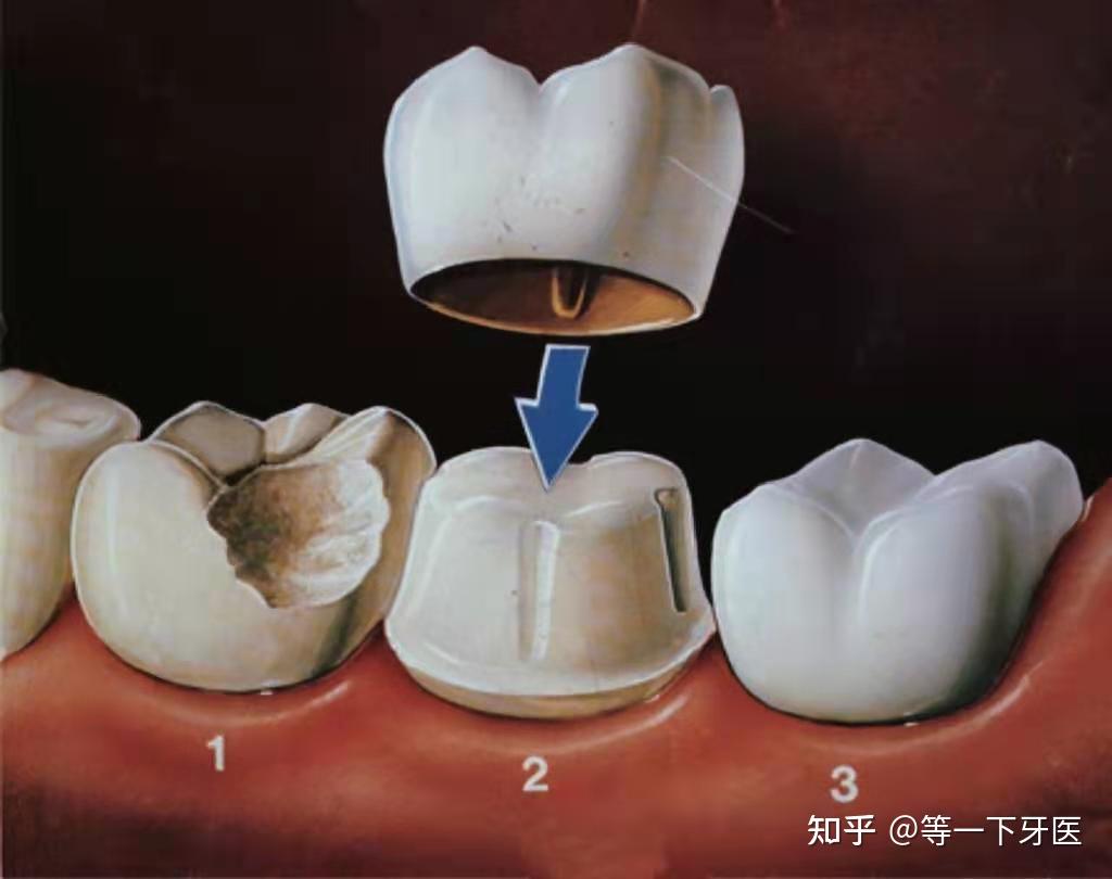 牙齿根管牙套图片