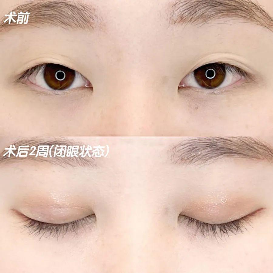 定点双眼皮——打造双眸焦点,散发自信魅力! - 知乎