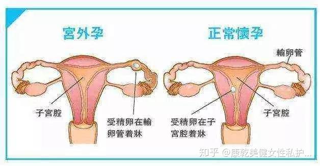 怎样能让月经提前停经 v2-f2c69246355f233e91f29b48e2b595a0_r.jpg