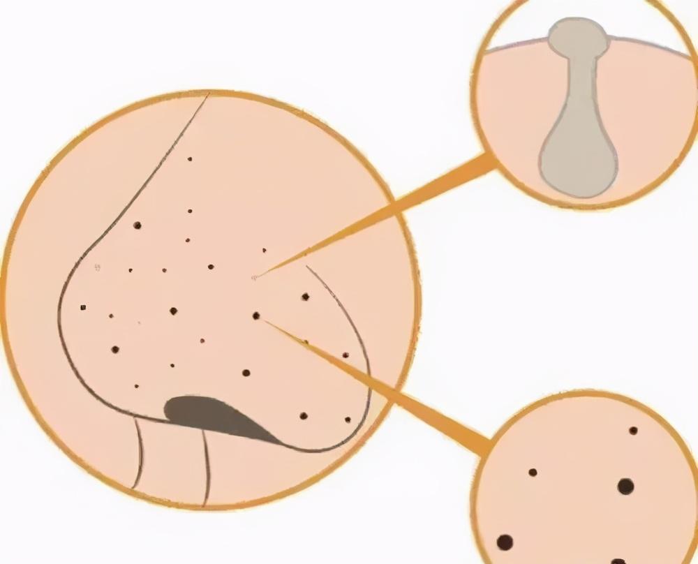 医学美容能解决皮肤毛孔粗大的问题吗?对皮肤有没有伤害?