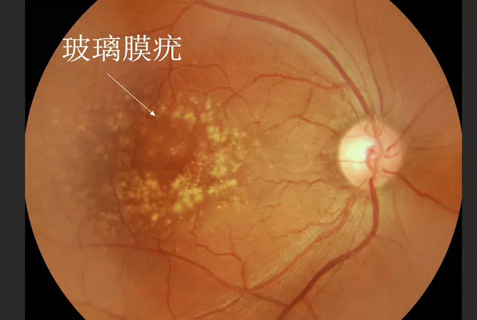 (玻璃膜疣是脂肪物质累积成为眼底视网膜色素上皮下的一种沉积物,是一